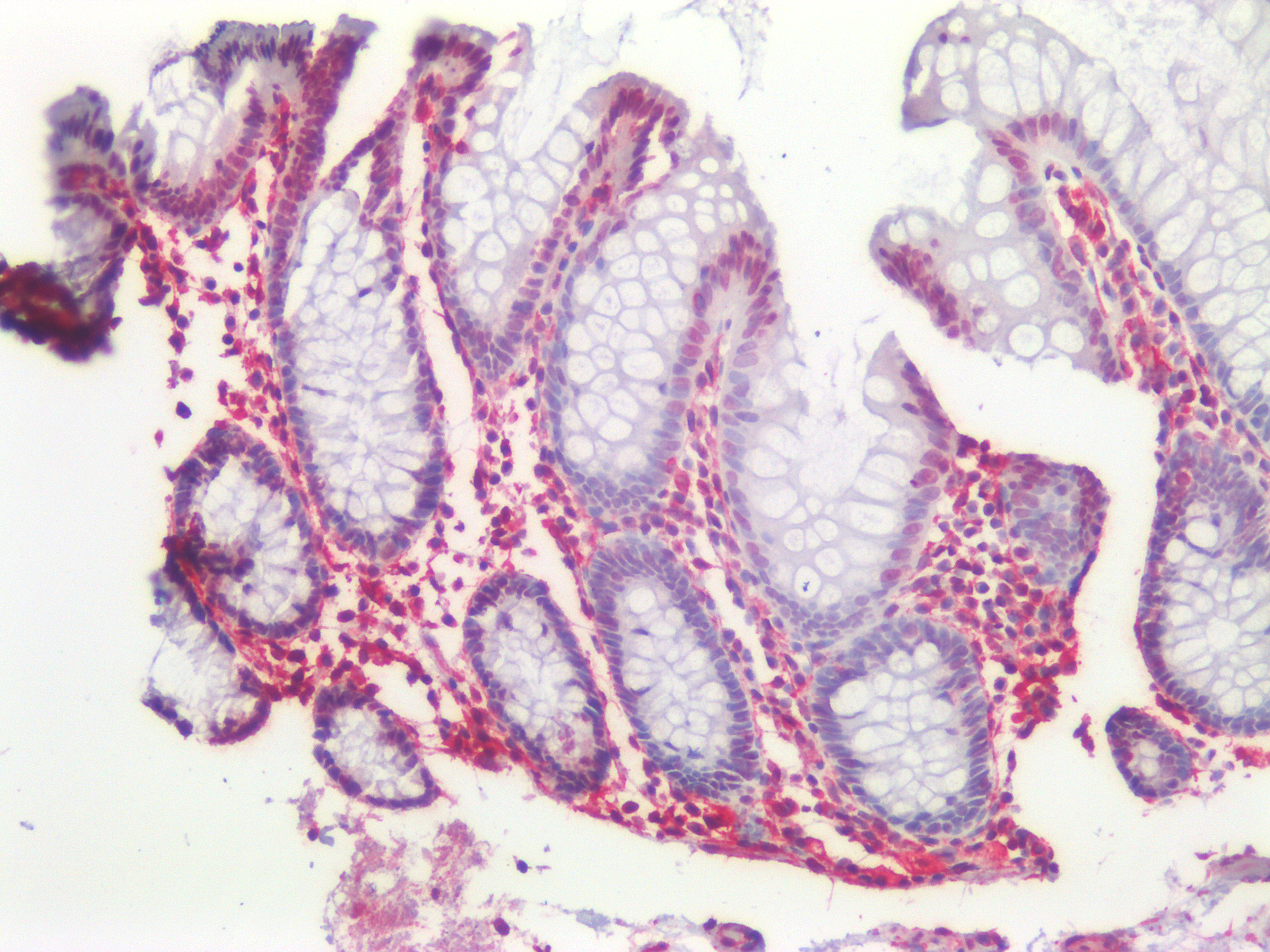 Figure 6. Immunostaining of human paraffin embedded tissue sections of human colon with MUB1904P (diluted 1:200), showing the specific pattern of vimentin in the mesenchymal cell types, such as fibroblasts in the connective tissue, and endothelial cells in blood vessels. As expected, no reactivity is seen in the epithelial cell compartment.